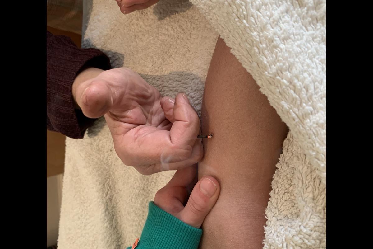 Praktijk de Libelle – Acupunctuur