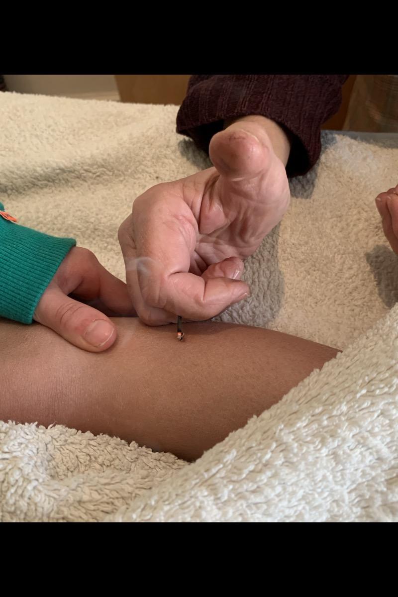 Acupunctuur behandeling Beneden-Leeuwen – Praktijk de Libelle